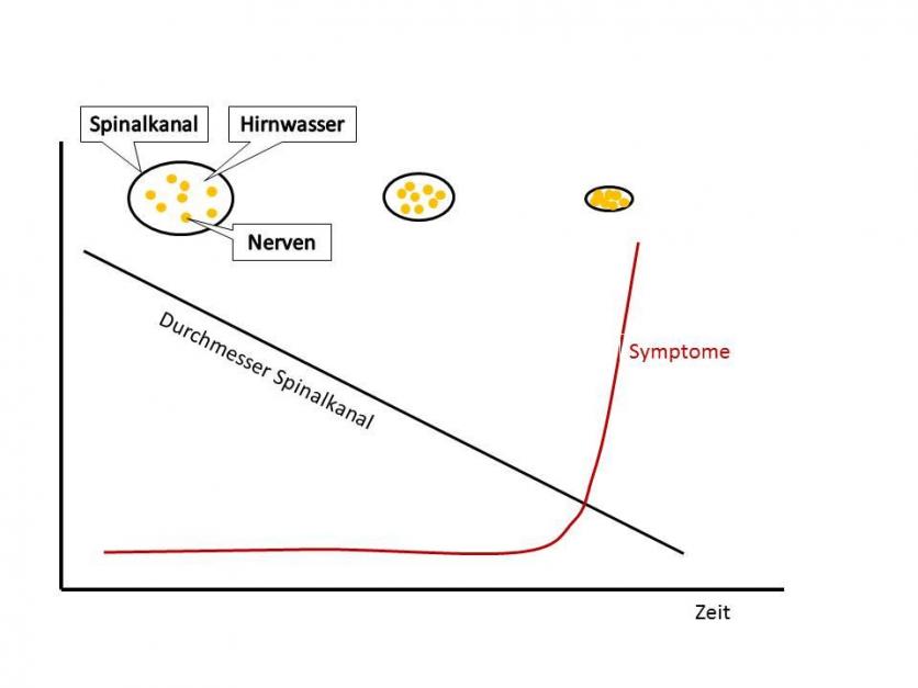 Verlauf der Symptomatik bei der Spinalkanalstenose