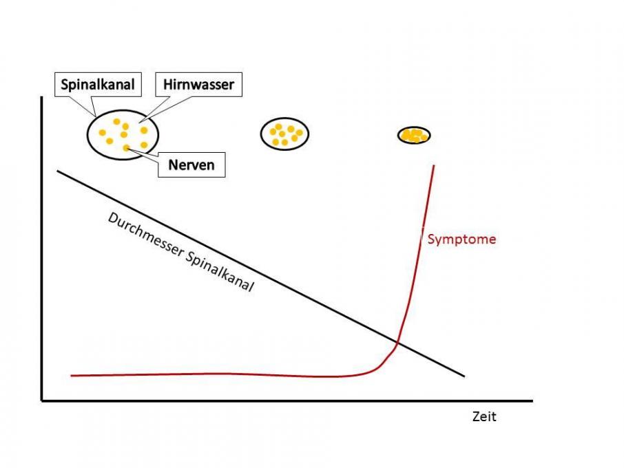 Verlauf der Symptomatik bei der Spinalkanalstenose