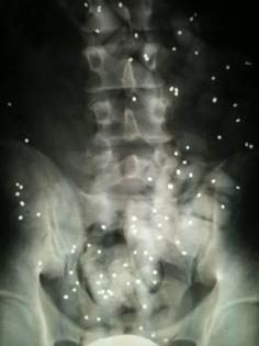 spezifische Ursache für Rückenschmerzen