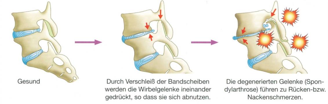 Osteochondrose der LWS