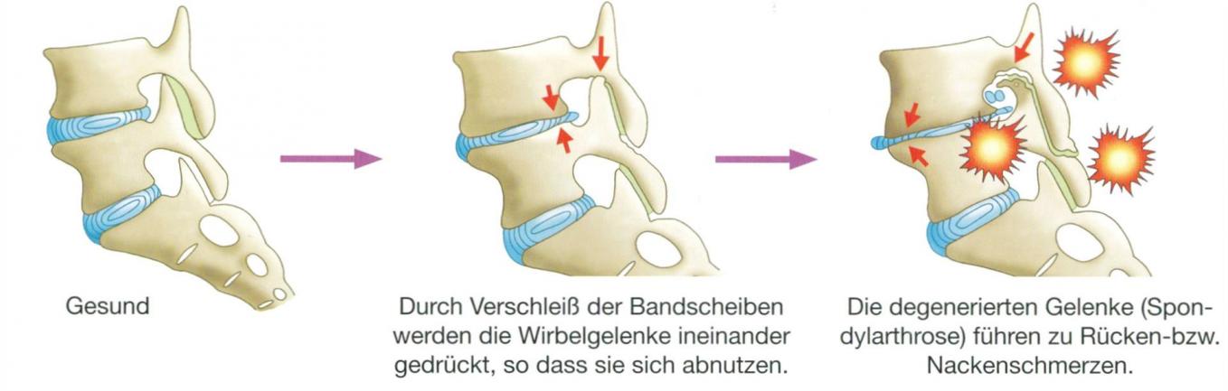 Osteochondrose der LWS