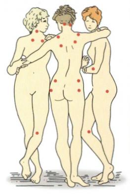Illustration dreier stilisierter Figuren, die mit verschiedenen roten Punkten auf den Körpern dargestellt werden.