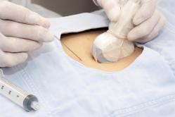 ultraschallgesteuerte Injektion